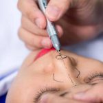 Tháo sụn mũi bao lâu thì lành? Có ảnh hưởng gì không? Khi nào làm lại được?