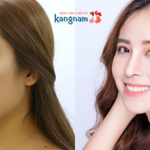 Giải đáp: Có nên nâng mũi ở bệnh viện Kangnam không?