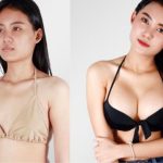 Bác sĩ Robert Nguyễn – Thẩm mỹ Bệnh viện Hồng Hà chia sẻ kinh nghiệm Nâng Ngực