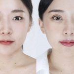 Cận cảnh quy trình cắt mí mắt tại Thẩm mỹ Bệnh viện Hồng Hà