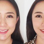 Gọt mặt Vline Hồng Hà có an toàn không?