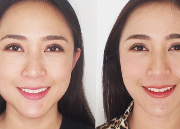 Gọt mặt Vline Hồng Hà có an toàn không?